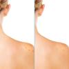 imageDifferin Acne Body Spray Acne Treatment with Salicylic Acid by the makers of Differin Gel 360 Formula for Back Acne Chest and Shoulders 6 oz