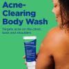 imageDifferin Acne Body Wash by the makers of Differin Gel Acne Treatment Cleanser with Salicylic Acid Cream to Lather Formula for Back Chest Shoulders 10 Oz