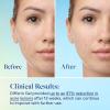 imageDifferin Acne Skin Care Kit Differin Gel Retinoid Acne Treatment for Face with 01 Adapalene ampamp 5 Benzoyl Peroxide Face Wash ampamp Body Wash Designed for Pimple and Acne Prone Skin