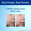 imageDifferin Acne Spot Treatment with 10 Benzoyl Peroxide Maximum Strength OTC Acne Treatment Fast Acting Spot Treatment for Face 1 oz