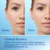 imageDifferin Acne Treatment Gel 30 Day Supply Retinoid Treatment for Face with 01 Adapalene Gentle Skin Care for Acne Prone Sensitive Skin 15g Tube Packaging May VaryTube