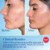 imageDifferin Acne Treatment Gel 30 Day Supply Retinoid Treatment for Face with 01 Adapalene Gentle Skin Care for Acne Prone Sensitive Skin 15g Tube Packaging May VarySingleDose Pump