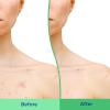 imageDifferin Body Scrub with Salicylic Acid Acne Clearing Improves Tone and Texture Prone Skin on Back Shoulders and Chest 8 Oz Packaging May Vary