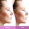 imageDifferin Gel Acne Scar Spot Treatment for Face Resurfacing Scar Gel Gentle Skin Care for Acne Prone Sensitive Skin 1 Oz Packaging May Vary